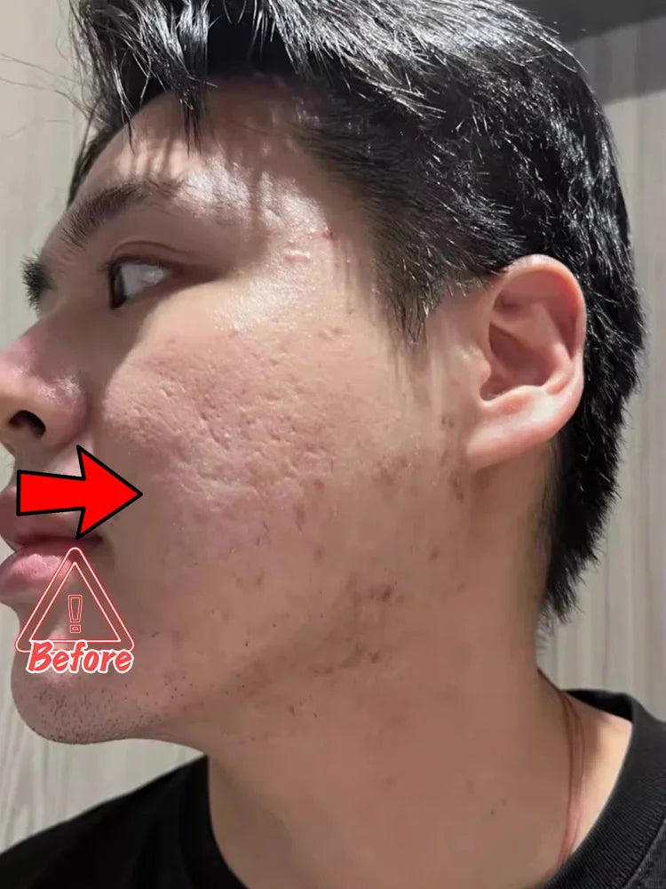 Pore Minimizing & Acne Scar Repair Cream – Smooth Skin for Men & Women