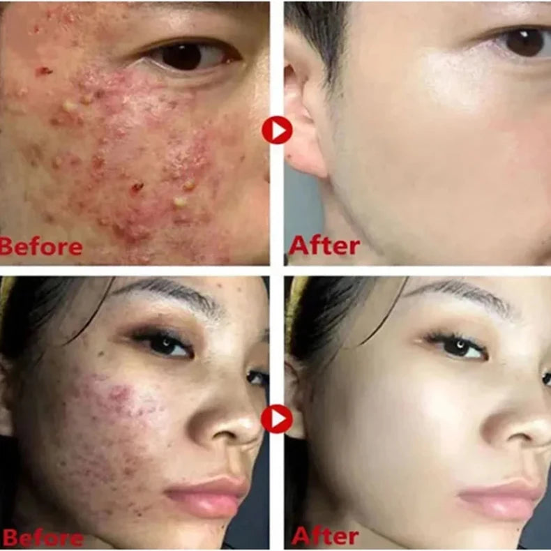 Mugwort Blackhead Removal Stick – Pore Cleansing Solid Mask for Smooth, Clear Skin