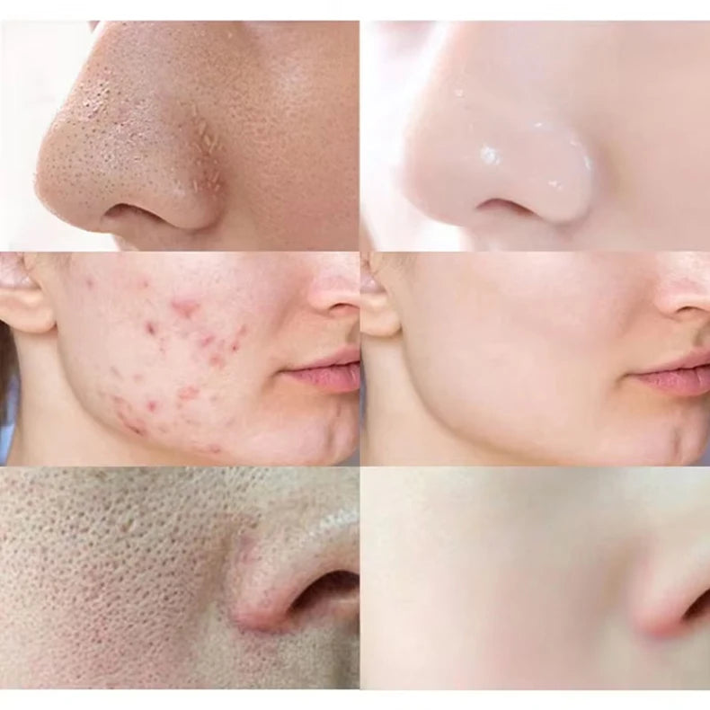 Mugwort Blackhead Removal Stick – Pore Cleansing Solid Mask for Smooth, Clear Skin