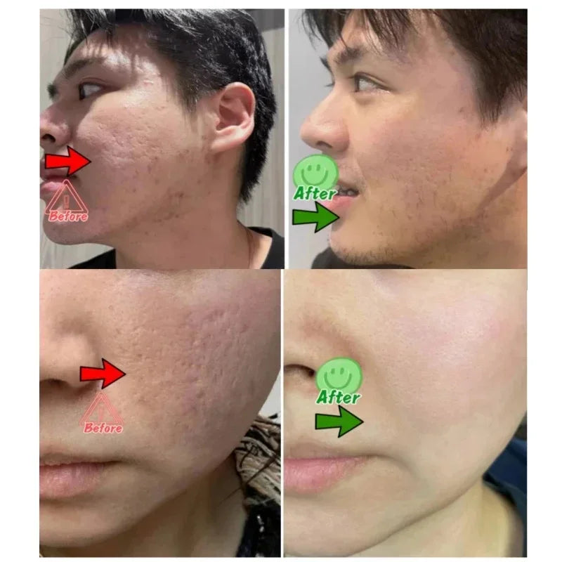 Pore Minimizing & Acne Scar Repair Cream – Smooth Skin for Men & Women